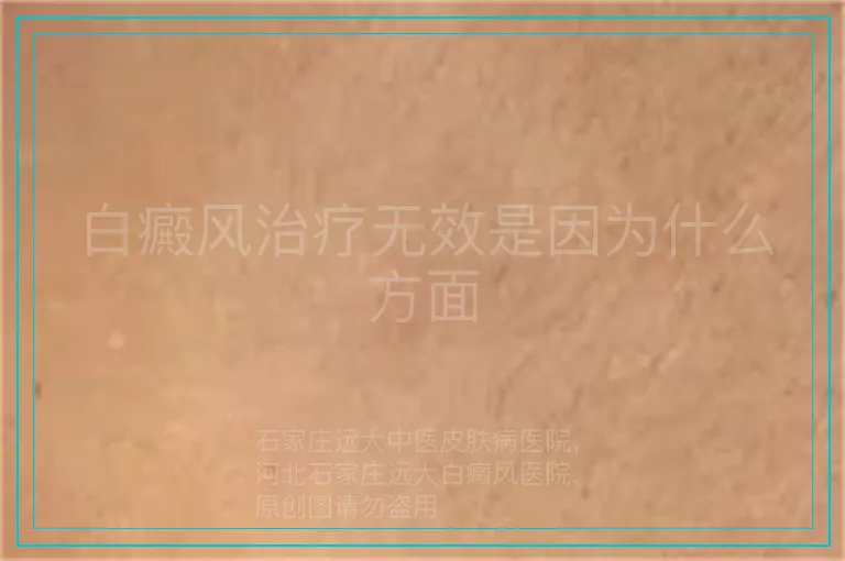 白癜风治疗无效是因为什么方面