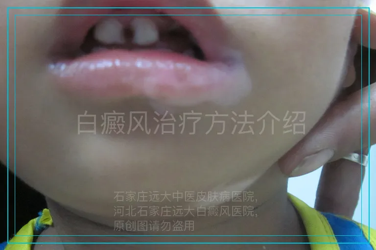 白癜风治疗方法介绍