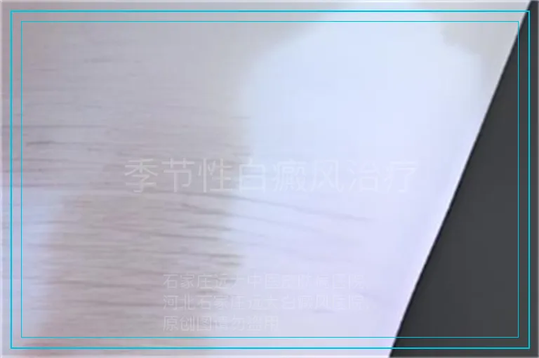 季节性白癜风治疗