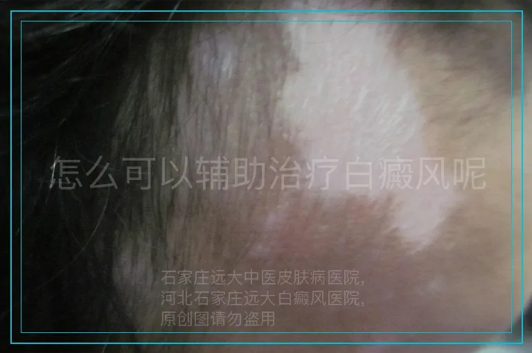 怎么可以辅助治疗白癜风呢
