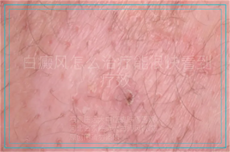 白癜风怎么治疗能很快看到疗效