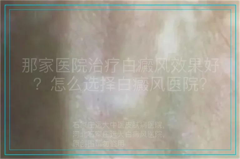 那家医院治疗白癜风效果好?怎么选择白癜风医院?