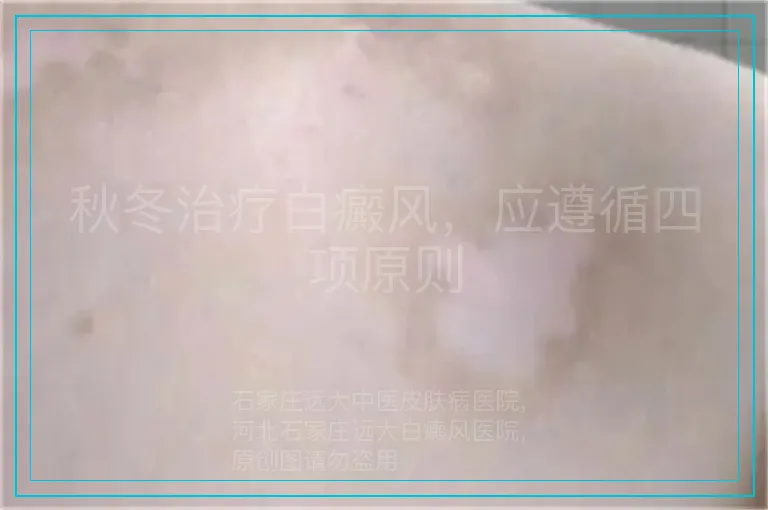 秋冬治疗白癜风,应遵循四项原则