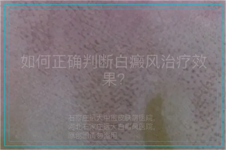 如何正确判断白癜风治疗效果？