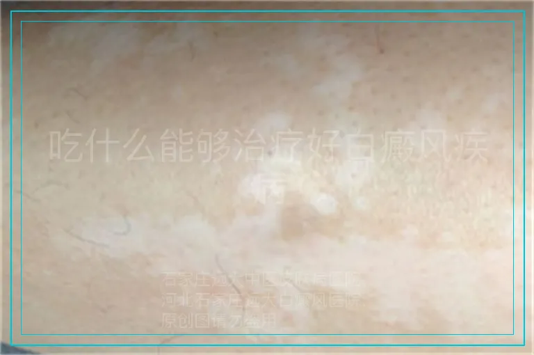 吃什么能够治疗好白癜风疾病