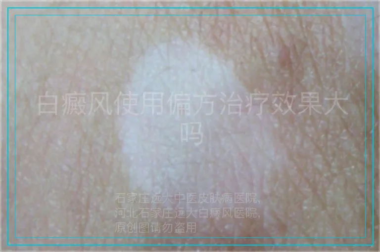 白癜风使用偏方治疗效果大吗
