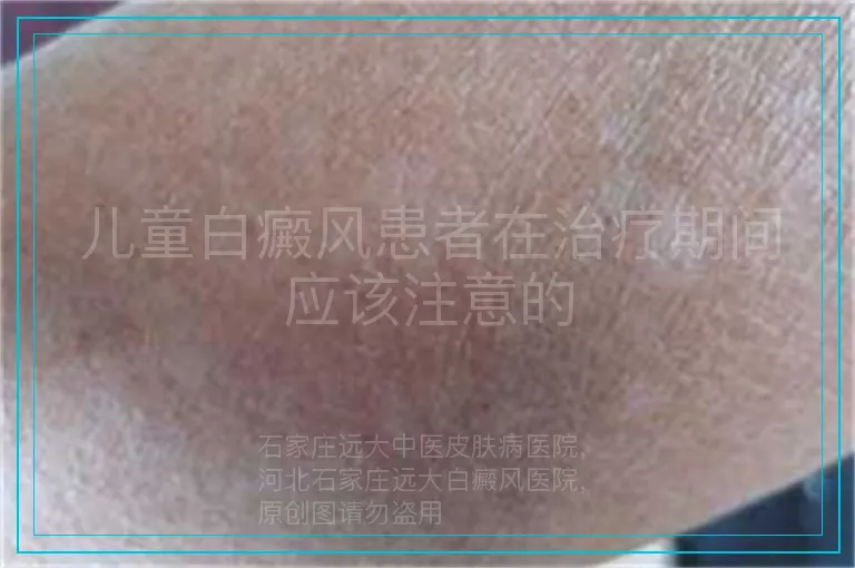 儿童白癜风患者在治疗期间应该注意的