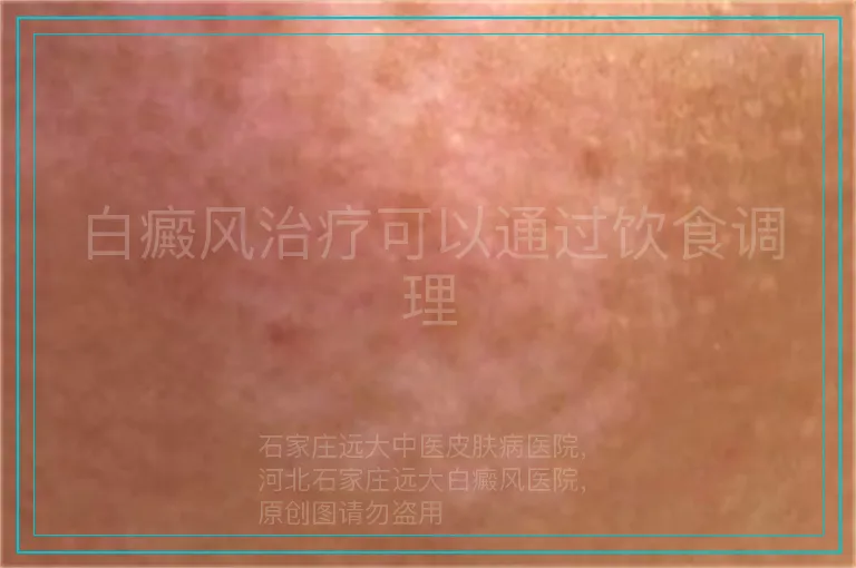 白癜风治疗可以通过饮食调理