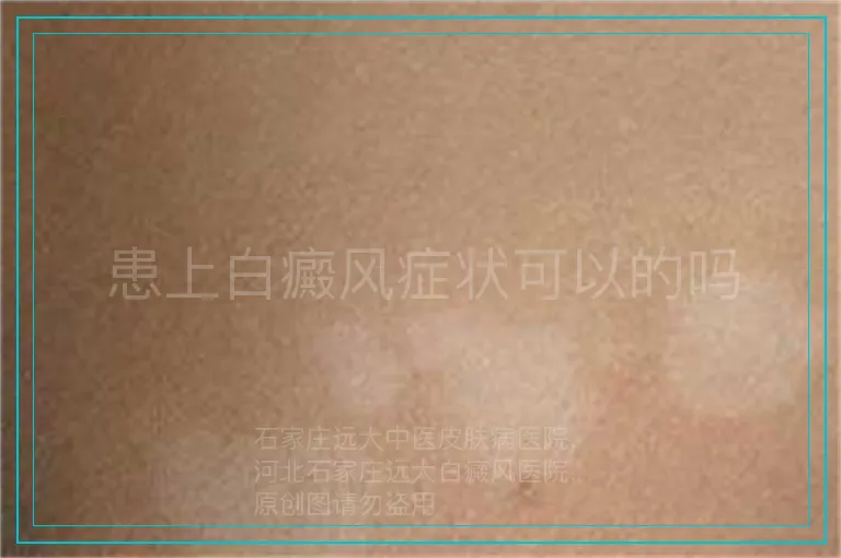 患上白癜风症状可以的吗
