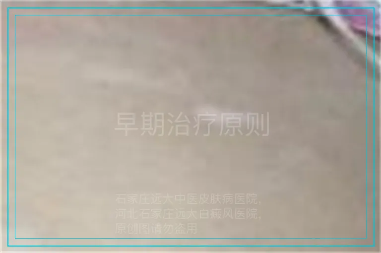 早期治疗原则
