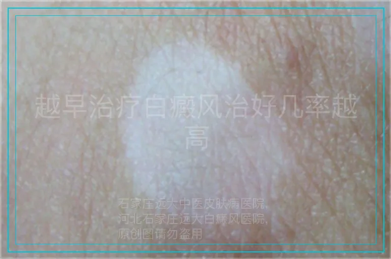 越早治疗白癜风治好几率越高