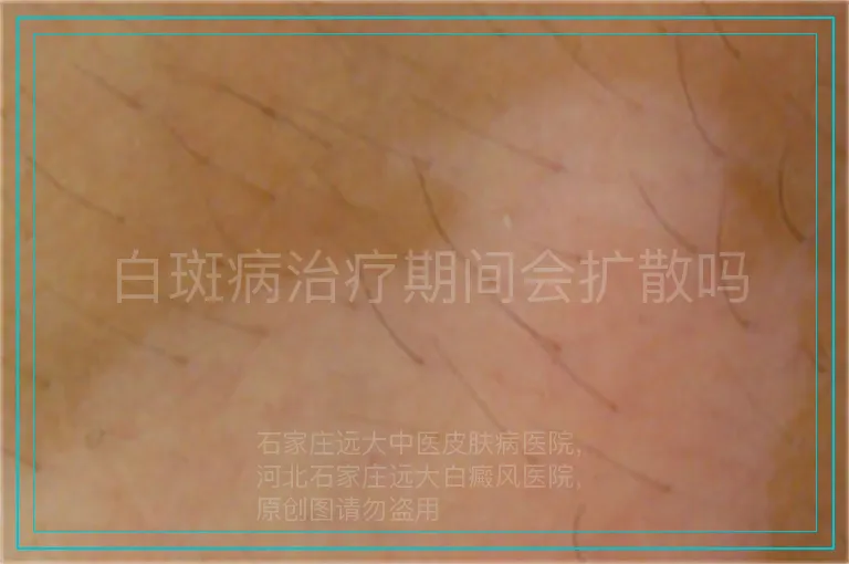 白斑病治疗期间会扩散吗