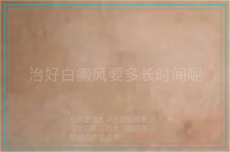 治好白癜风要多长时间呢