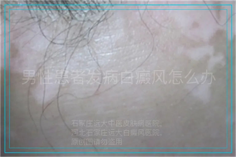 男性患者发病白癜风怎么办