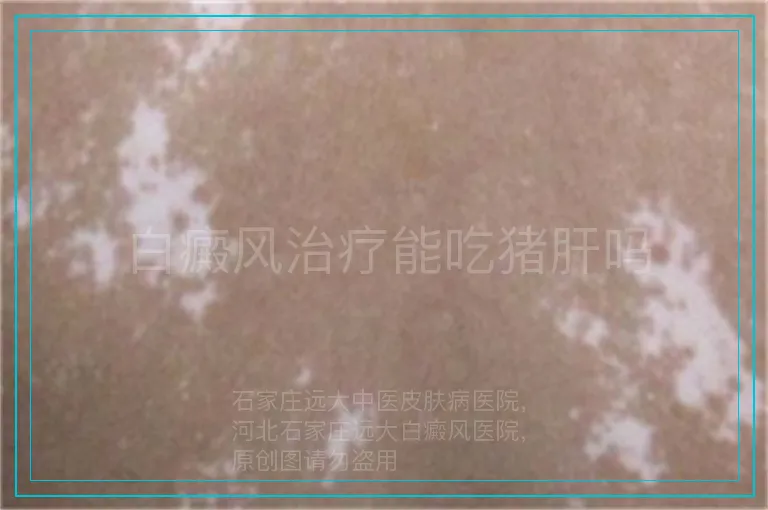 白癜风治疗能吃猪肝吗