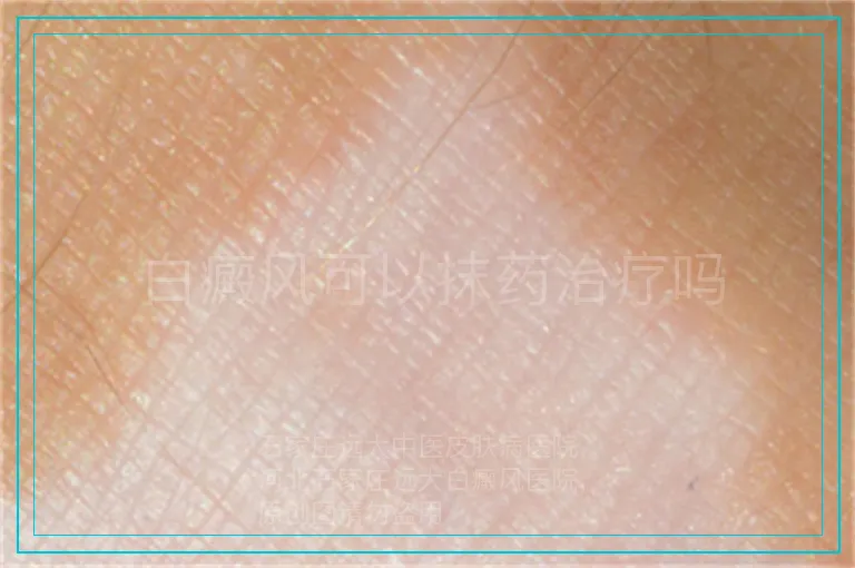 白癜风可以抹药治疗吗