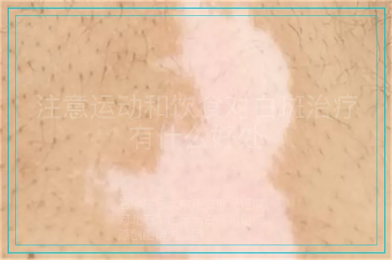 注意运动和饮食对白斑治疗有什么好处