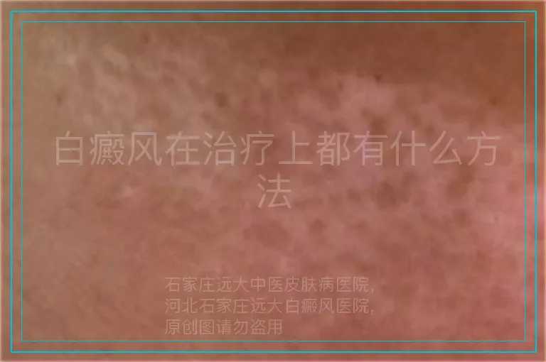 白癜风在治疗上都有什么方法