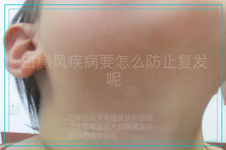 白癜风疾病要怎么防止复发呢