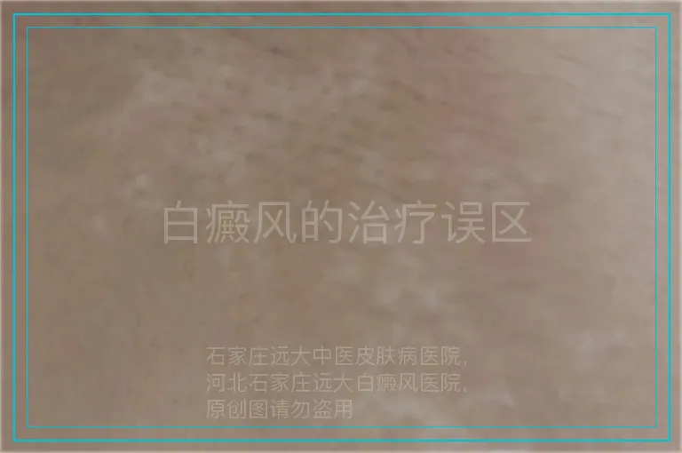 白癜风的治疗误区