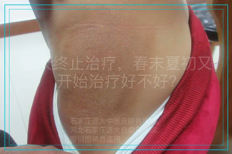 冬天终止治疗,春末夏初又开始治疗好不好?