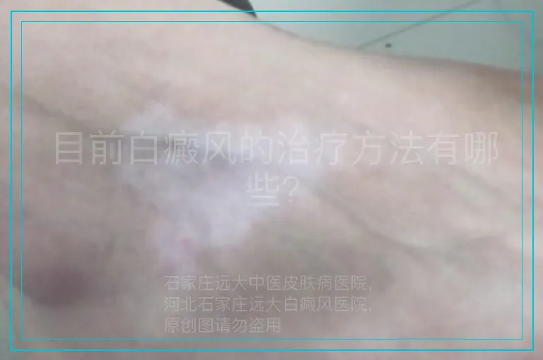 目前白癜风的治疗方法有哪些?