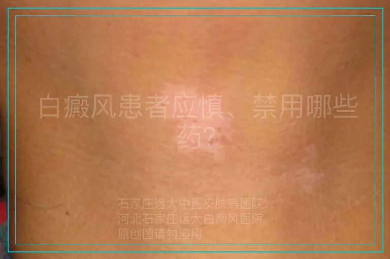 白癜风患者应慎、禁用哪些药？