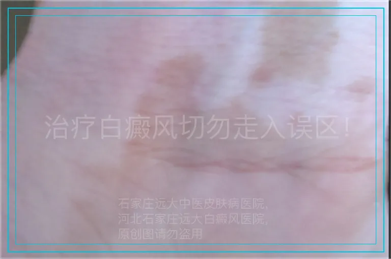 治疗白癜风切勿走入误区！