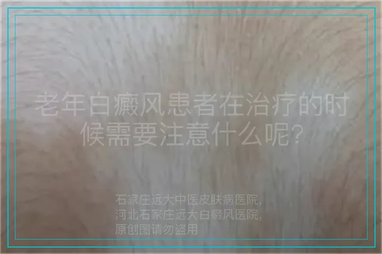 老年白癜风患者在治疗的时候需要注意什么呢?