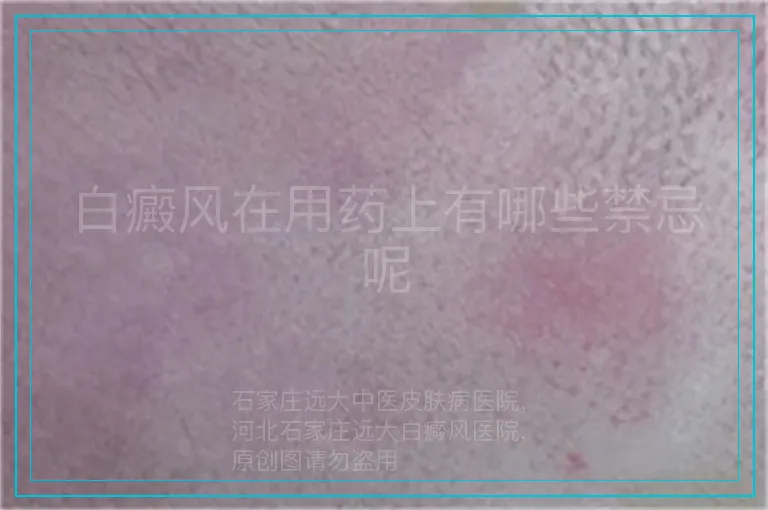 白癜风在用药上有哪些禁忌呢