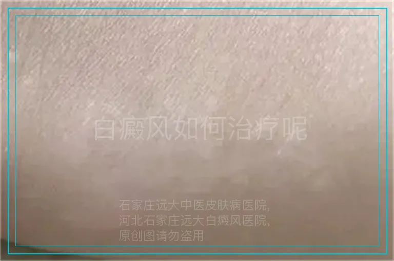 白癜风如何治疗呢