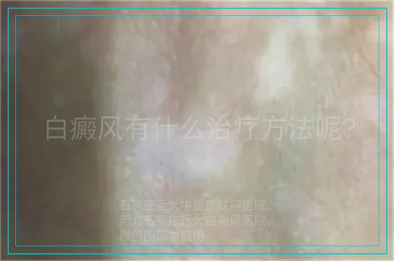 白癜风有什么治疗方法呢?