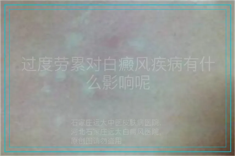 过度劳累对白癜风疾病有什么影响呢