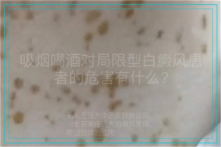 吸烟喝酒对局限型白癜风患者的危害有什么?