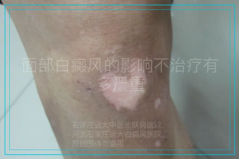 面部白癜风的影响不治疗有多严重