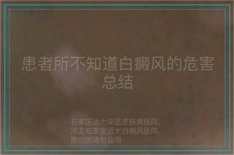 患者所不知道白癜风的危害总结