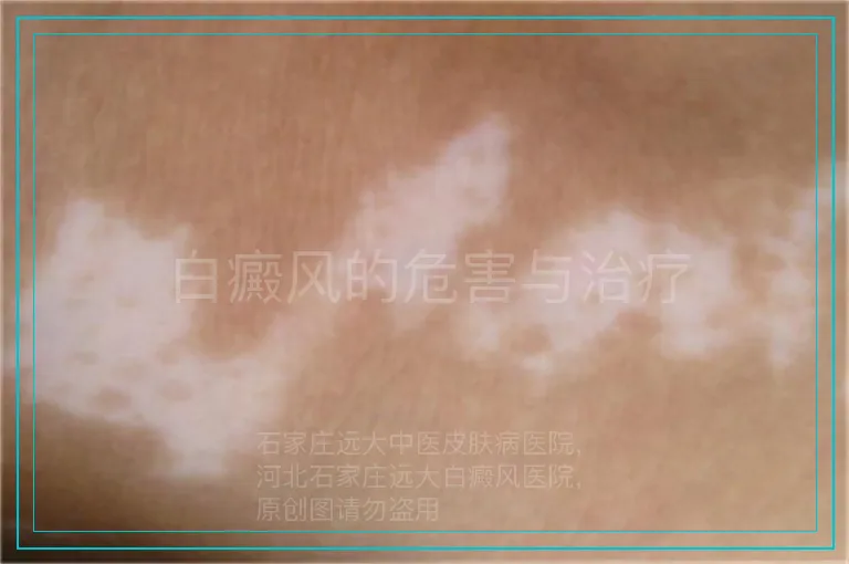 白癜风的危害与治疗