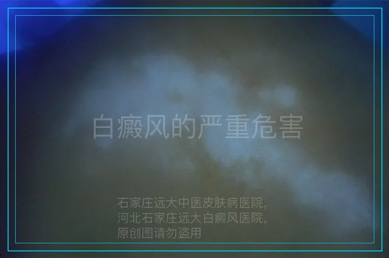 白癜风的严重危害