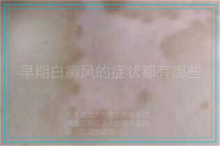 早期白癜风的症状都有哪些