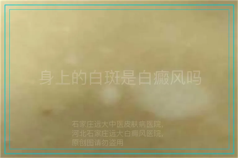 身上的白斑是白癜风吗