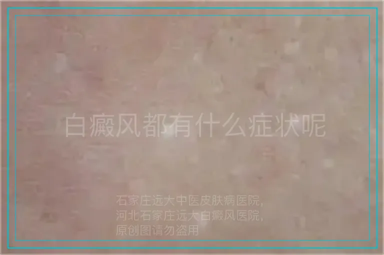 白癜风都有什么症状呢