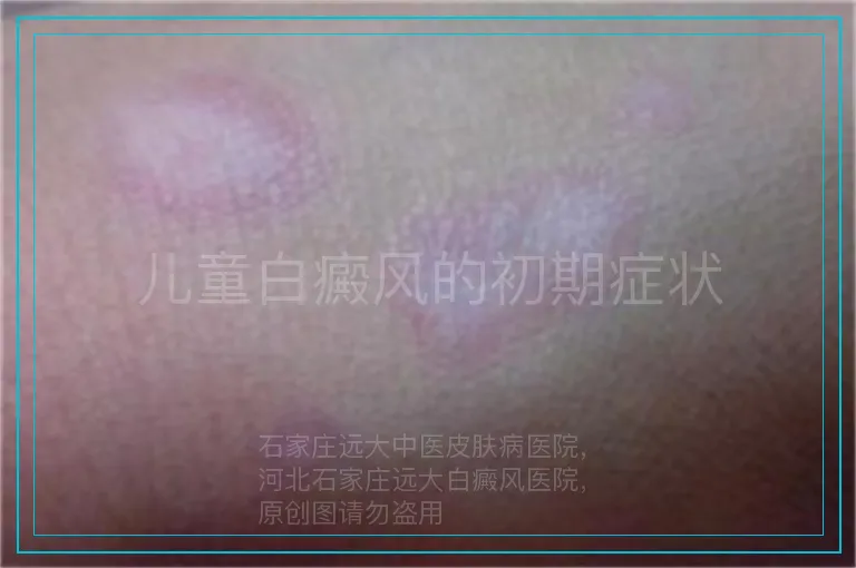 儿童白癜风的初期症状