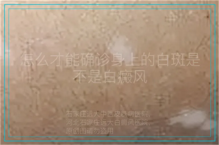 怎么才能确诊身上的白斑是不是白癜风