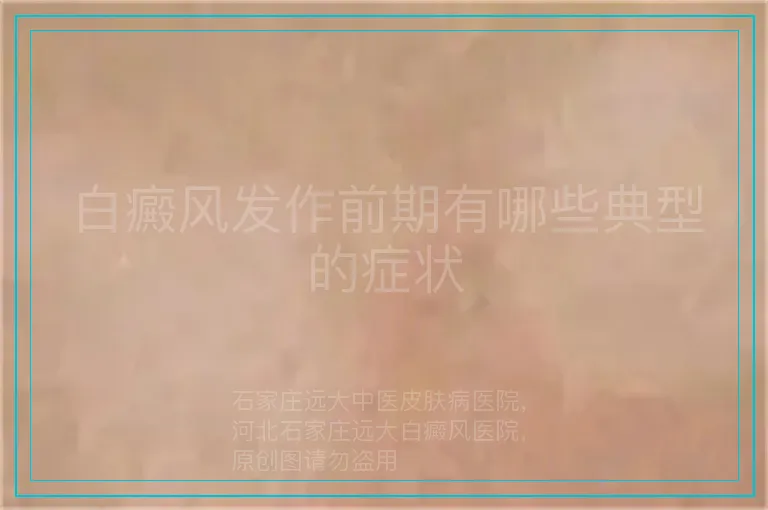 白癜风发作前期有哪些典型的症状