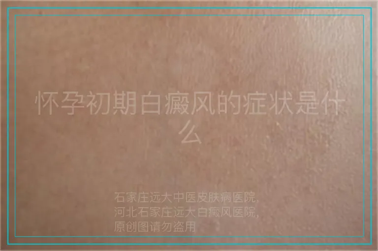 怀孕初期白癜风的症状是什么