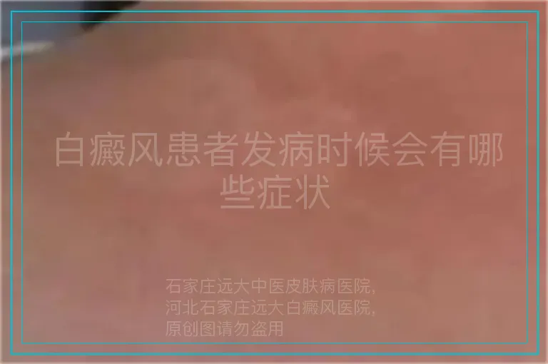 白癜风患者发病时候会有哪些症状