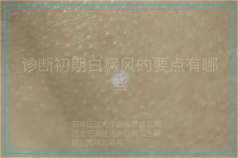 诊断初期白癜风的要点有哪些