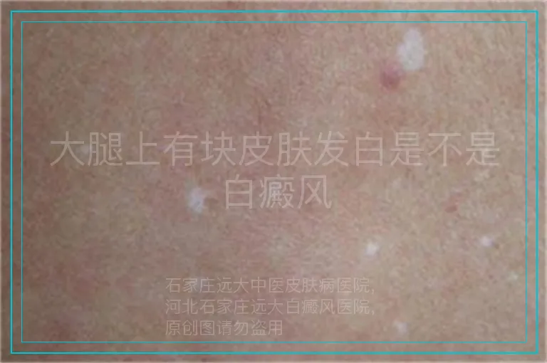 大腿上有块皮肤发白是不是白癜风