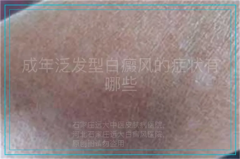 成年泛发型白癜风的症状有哪些