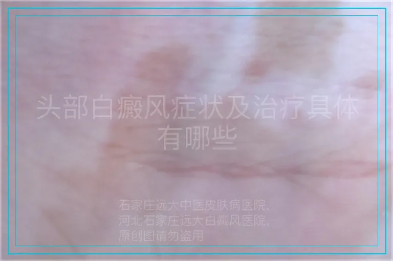 头部白癜风症状及治疗具体有哪些